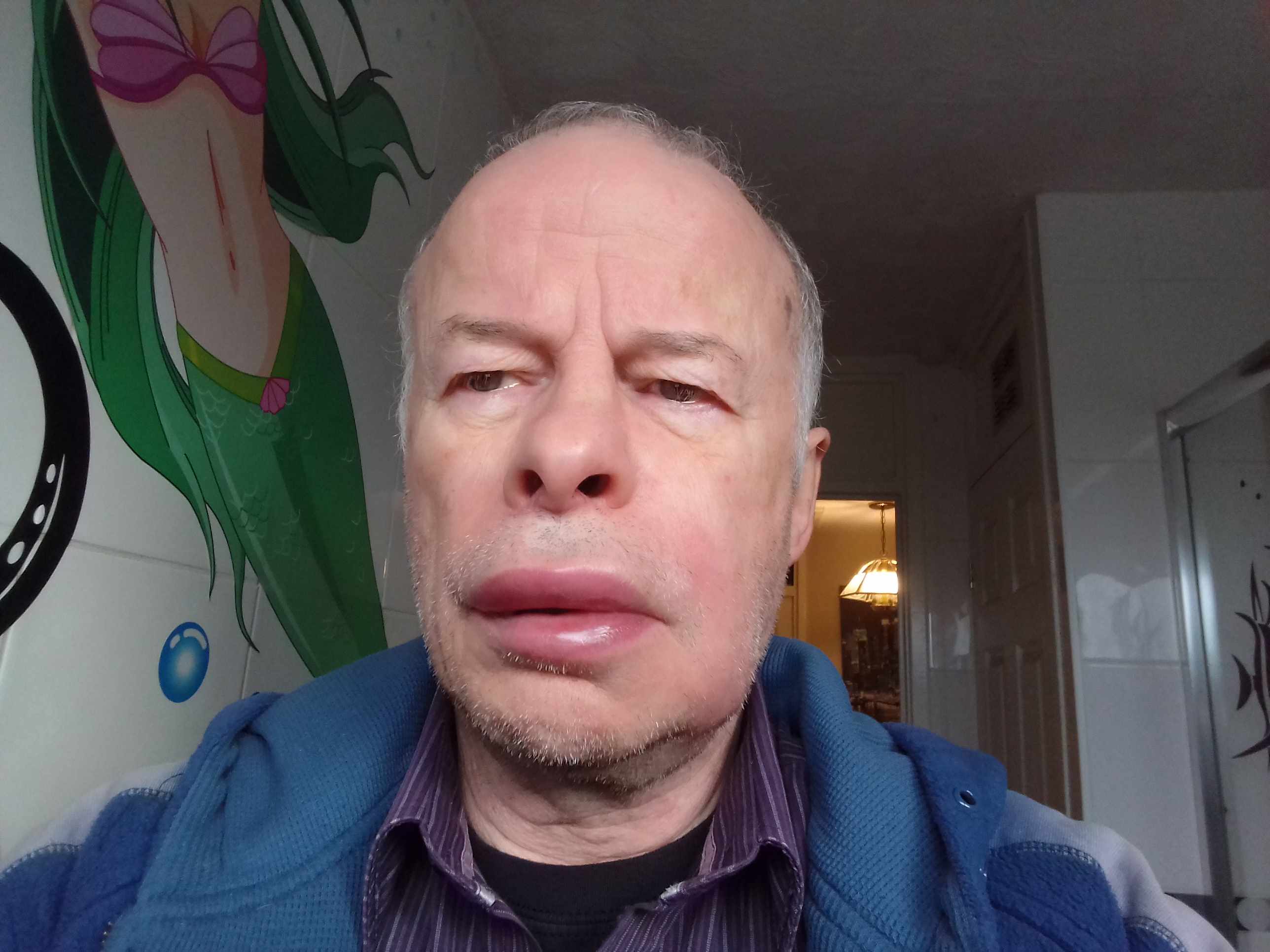 21_WTN_2019-12_Nigel_Allen_allergy_lips.jpg